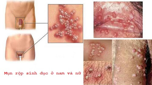 Hình ảnh mụn rộp sinh dục ở nam và nữ giới